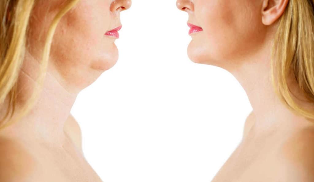 Double Chin treatment Stonebridge before and after results