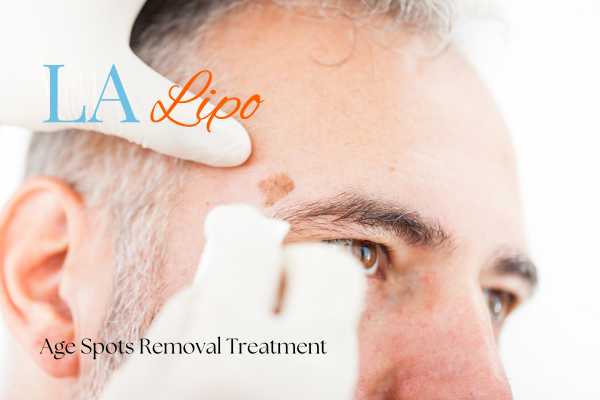 What Are the Most Effective Treatments for Age Spots Stonebridge?