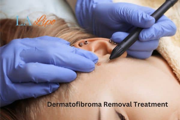 Dermatofibroma Removal Treatment Stonebridge