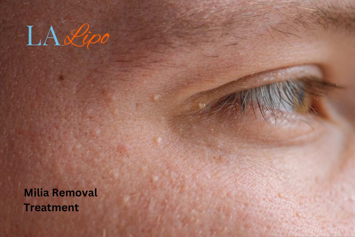 Cryopen Milia Removal: Is It the Easiest and Safest Option Stonebridge?