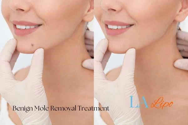 Before-and-after results following benign mole-removal treatment Stonebridge