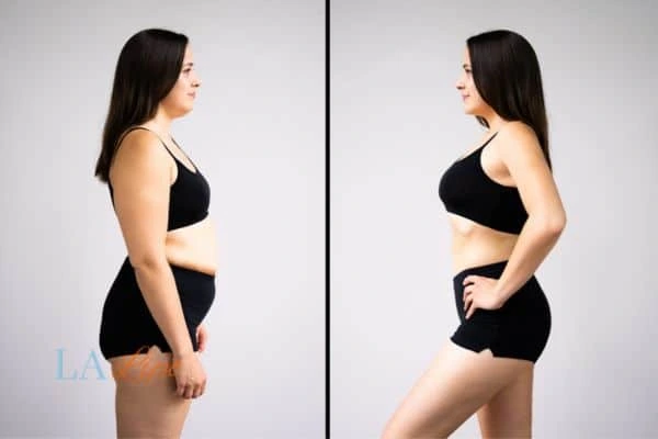 image of woman before and after results of LA-EMS Body Sculpting Stonebridge to help treat Diastasis recti