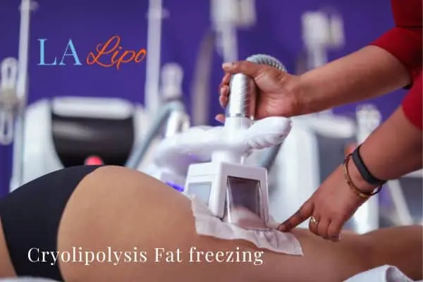 women getting fat freezing Stonebridge
