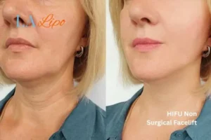hi-fu for wrinkles Stonebridge before and after results