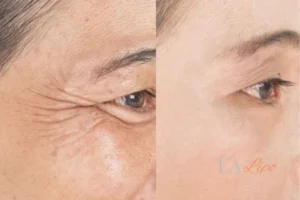 Before and after results of woman - HI-fu wrinkles reduction treatment Stonebridge