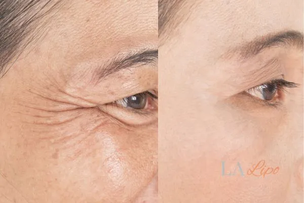 Before and after results of woman - HI-fu wrinkles reduction treatment Stonebridge