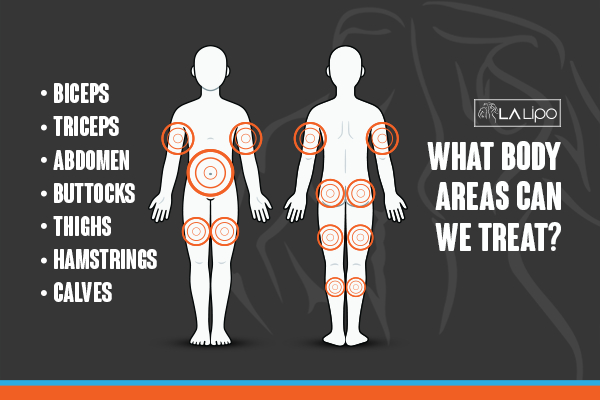 Graphic to show areas you can have LA-EMS Body Sculpting Stonebridge treatment.