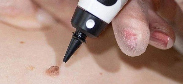 skin tag removal using cryopen Stonebridge