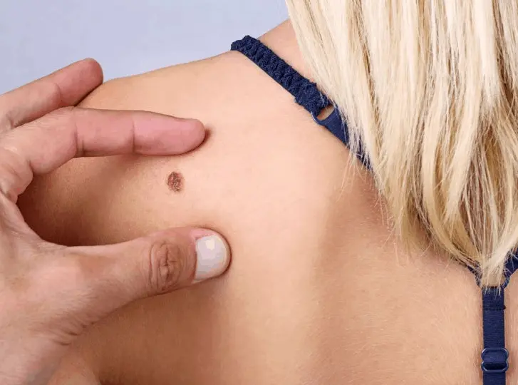 woman having mole removal Stonebridge consultation before treatment.