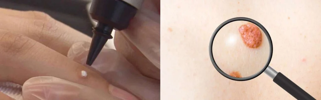 CryoPen practitioner Stonebridge assessing a benign mole before treatment