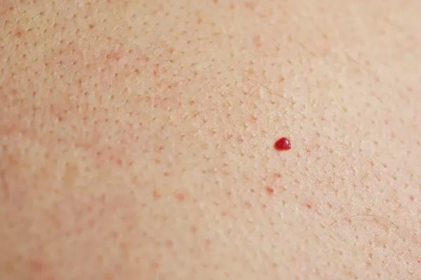 close up of a cherry angioma Stonebridge