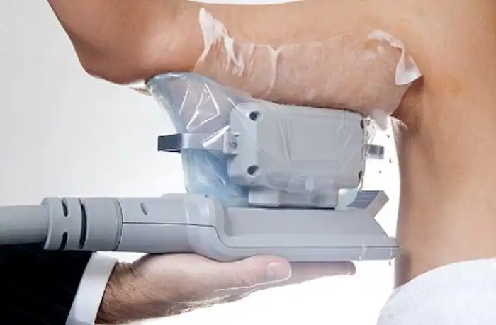 Picture of fat freezing Stonebridge on the upper arms.