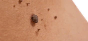 image of a skin tag Stonebridge