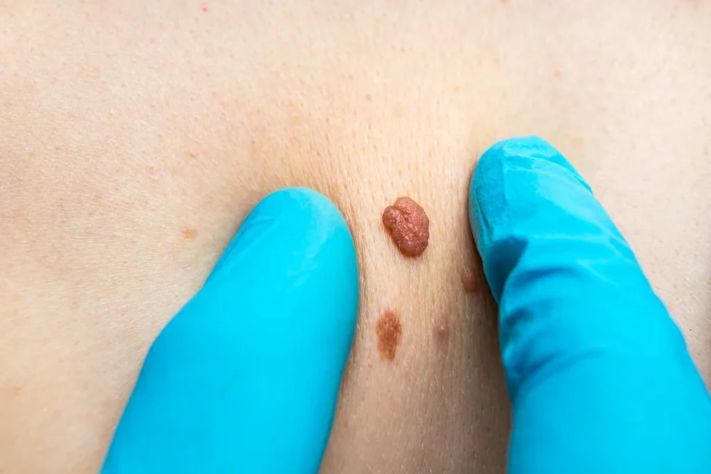 Consultant examining a skin tag Stonebridge