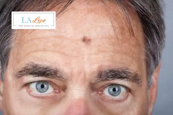 Solar Lentigo Removal Stonebridge image of man with mark on his forehead