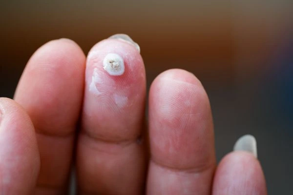 wart on person finger - cryotherapy to treat from LA LIPO Stonebridge