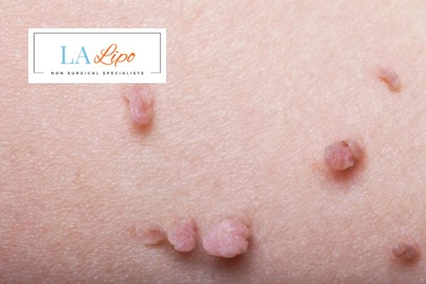 Does cryopen skin tag removal Stonebridge hurt? Find out now call our team today!