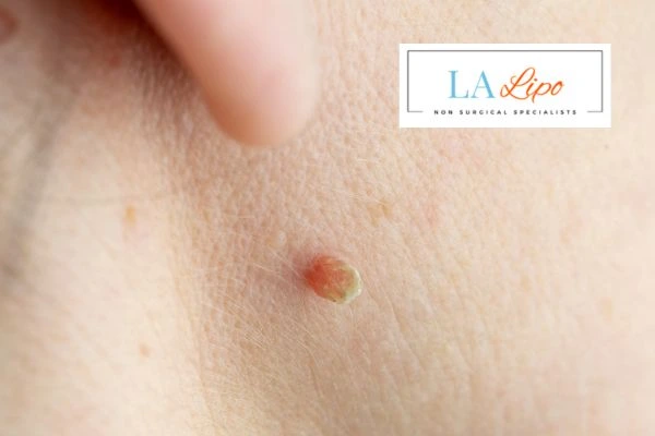 Book skin tag removal Stonebridge today speak to our team now!