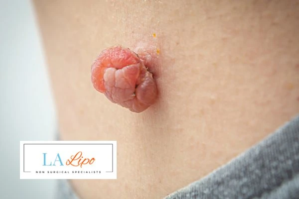 Interested in skin tag removal Stonebridge? Concerned about the pain? Find out more today!