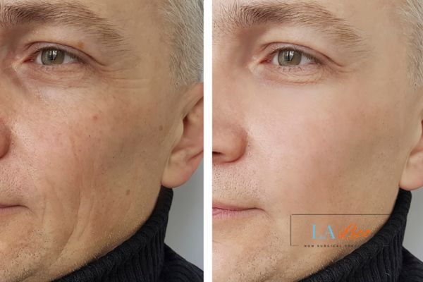 See the amazing results of Morpheus8 Treatment Stonebridge!