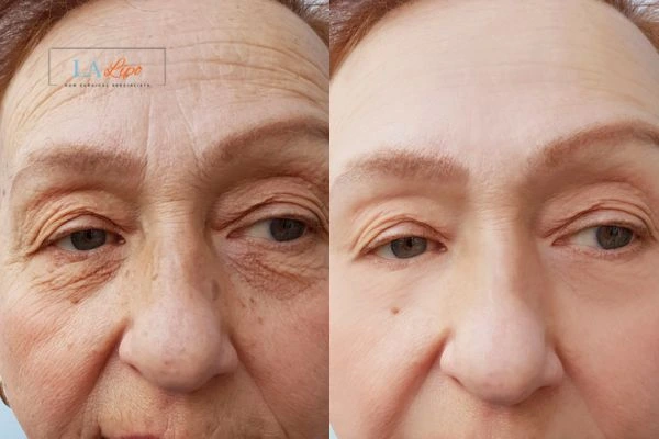The powerful benefits of Morpheus8 Treatment Stonebridge - Call Our team today!