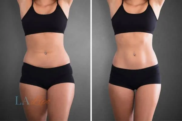 before and after results of non-surgical treatment to help a woman's body image and mental health Stonebridge