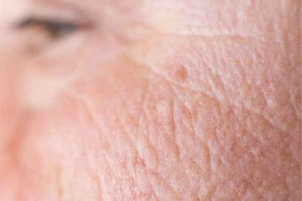 close up picture of a woman's face showing an age spot Stonebridge