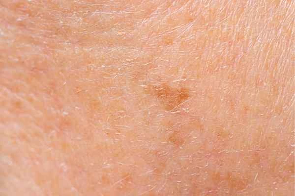 close up picture of age spots Stonebridge