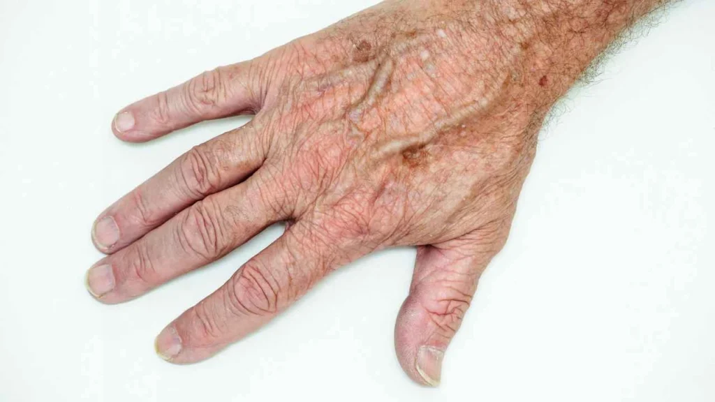 Male hand showing age spot Stonebridge