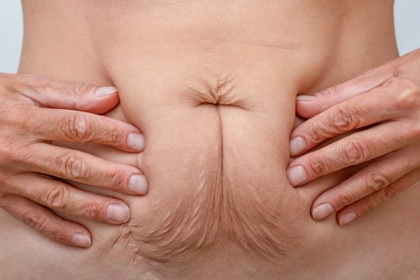 Should I Combine Diastasis Recti Treatment with Body Contouring for Better Results Stonebridge?