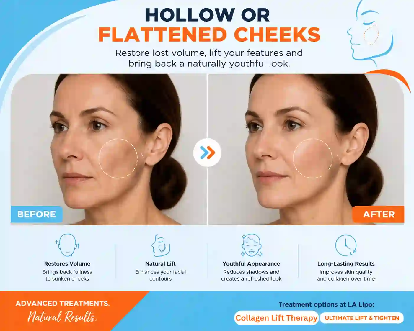 Sign #4: Hollow or Flattened Cheeks Stonebridge