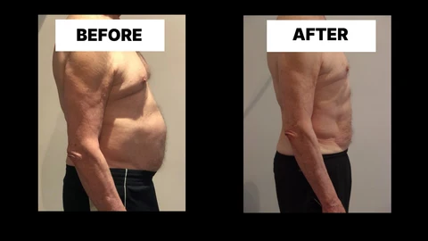 What Symptoms Can Diastasis Recti Cause in Men? Weak Core, Back Pain and Poor Posture Stonebridge